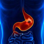 PepticUlcer_share-scaled